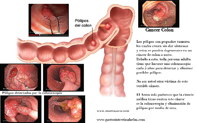 Prevención cáncer de colon y recto