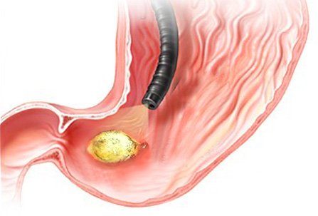ulcers - Notes on Cyber Gastroenterology - murrasaca.com helicobacter pylori esophagus diagram 